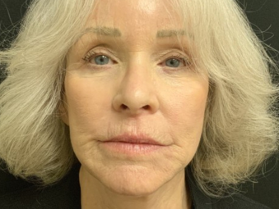 Patient #12478: Vollure After Image