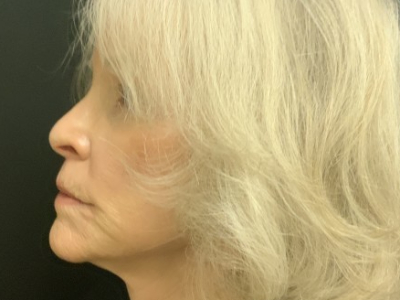 Patient #12478: Vollure After Image