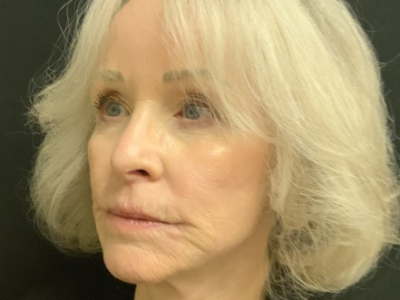 Patient #12478: Vollure After Image