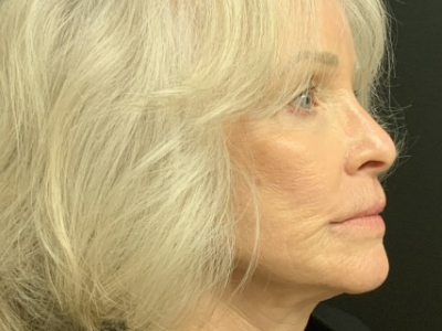 Patient #12478: Vollure After Image