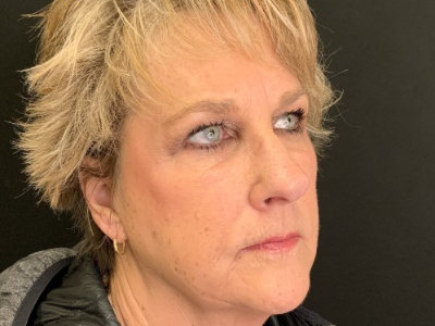 Patient #69569: Juvéderm After Image