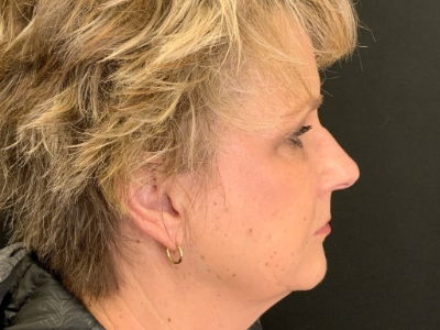 Patient #69569: Juvéderm After Image