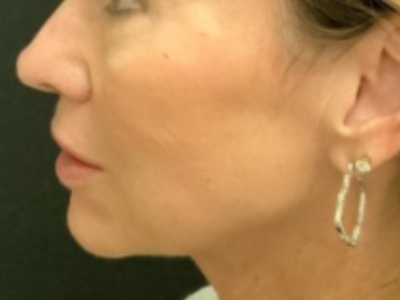 Patient #14598: Volbella After Image