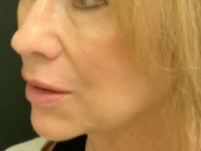 Patient #14598: Volbella After Image