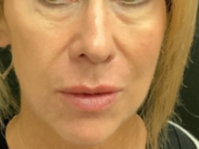 Patient #14598: Volbella After Image