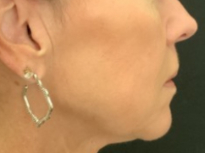 Patient #14598: Volbella Before Image