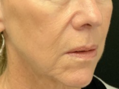 Patient #14598: Volbella Before Image