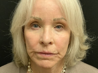 Patient #12478: Vollure Before Image