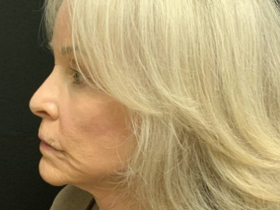 Patient #12478: Vollure Before Image