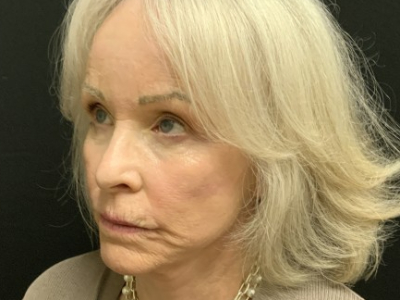 Patient #12478: Vollure Before Image