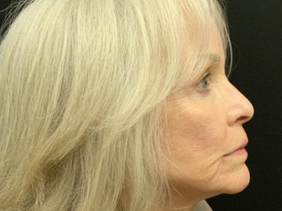 Patient #12478: Vollure Before Image