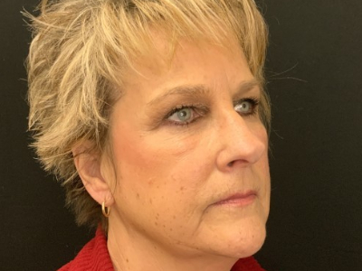 Patient #69569: Juvéderm Before Image