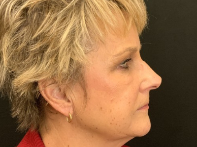 Patient #69569: Juvéderm Before Image