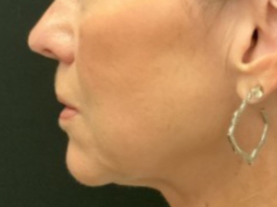 Patient #14598: Volbella Before Image