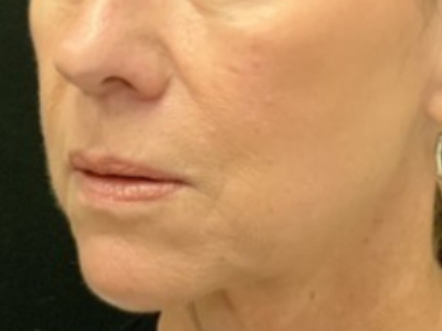 Patient #14598: Volbella Before Image