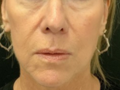 Patient #14598: Volbella Before Image