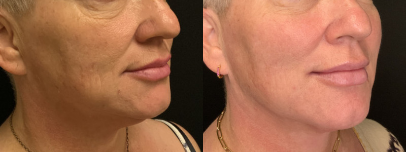 Patient #52468: Lip Filler Combine Image