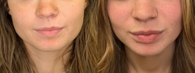 Patient #64588: Lip Filler Combine Image