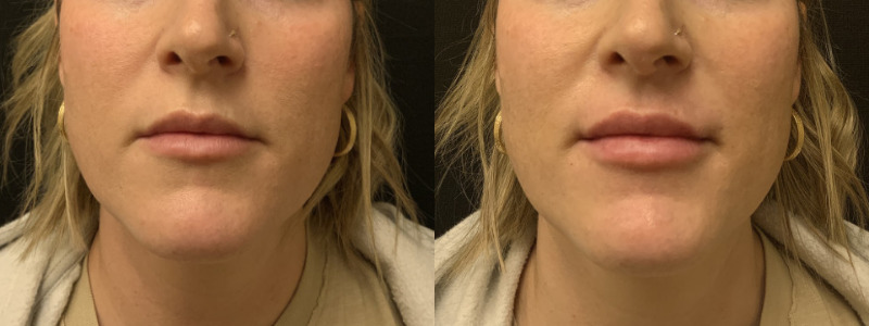 Patient #34857: Lip Filler Combine Image