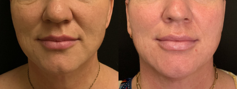 Patient #52468: Lip Filler Combine Image