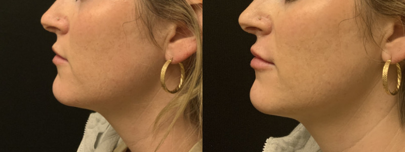 Patient #34857: Lip Filler Combine Image