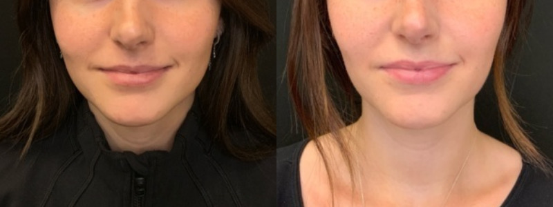 Patient #55485: Volbella Combine Image