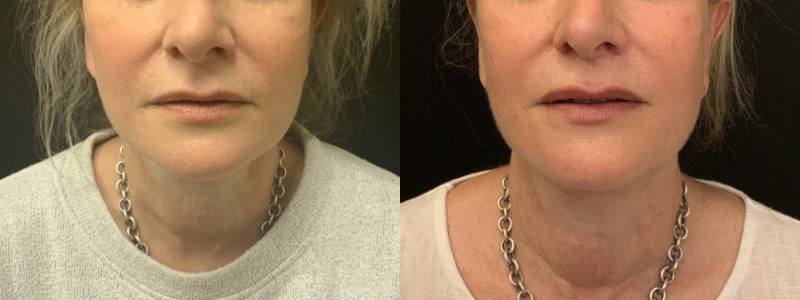 Patient #32564: Lip Filler Combine Image