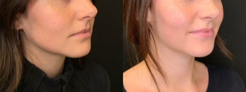 Patient #55485: Volbella Combine Image