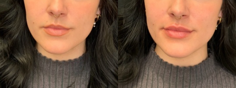 Patient #34568: Lip Filler Combine Image