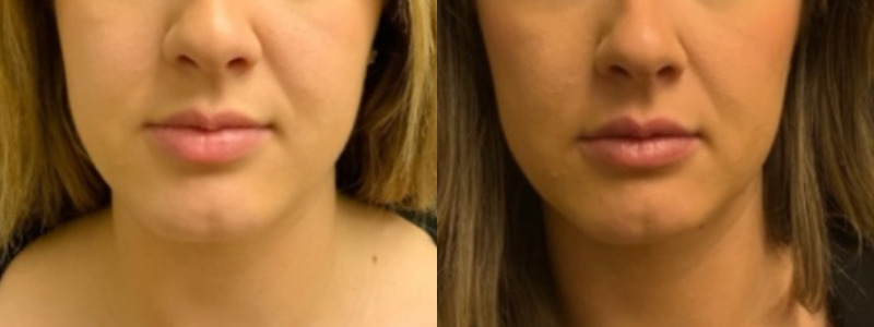 Patient #14589: Juvederm Combine Image