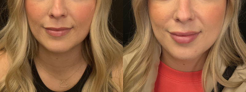 Patient #85426: Lip Filler Combine Image