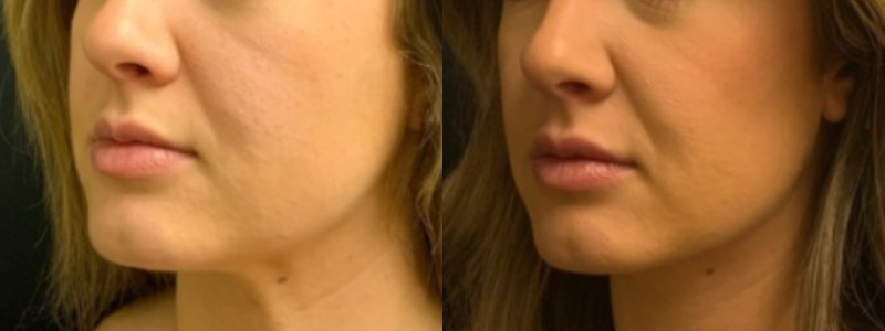 Patient #14589: Juvederm Combine Image