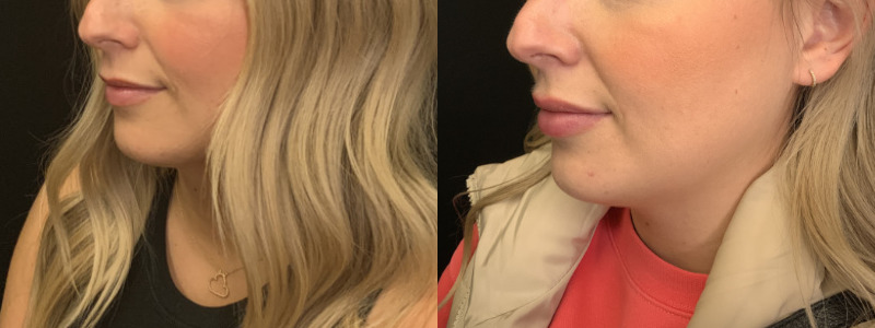 Patient #85426: Lip Filler Combine Image