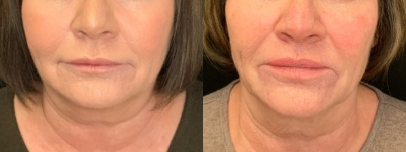 Patient #35265: Voluma & Volbella Combine Image