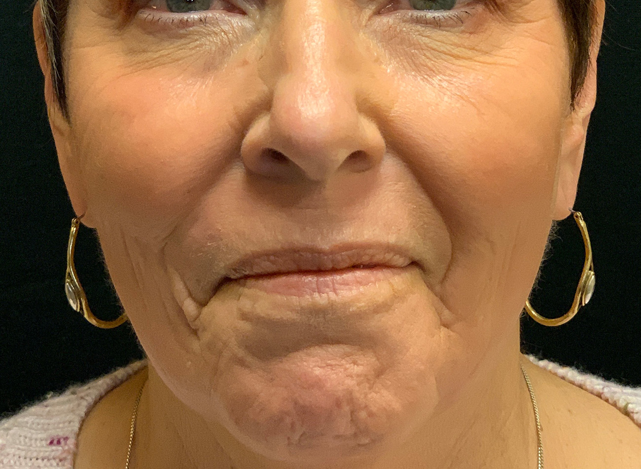 Patient #27263: Ablative Laser After Image