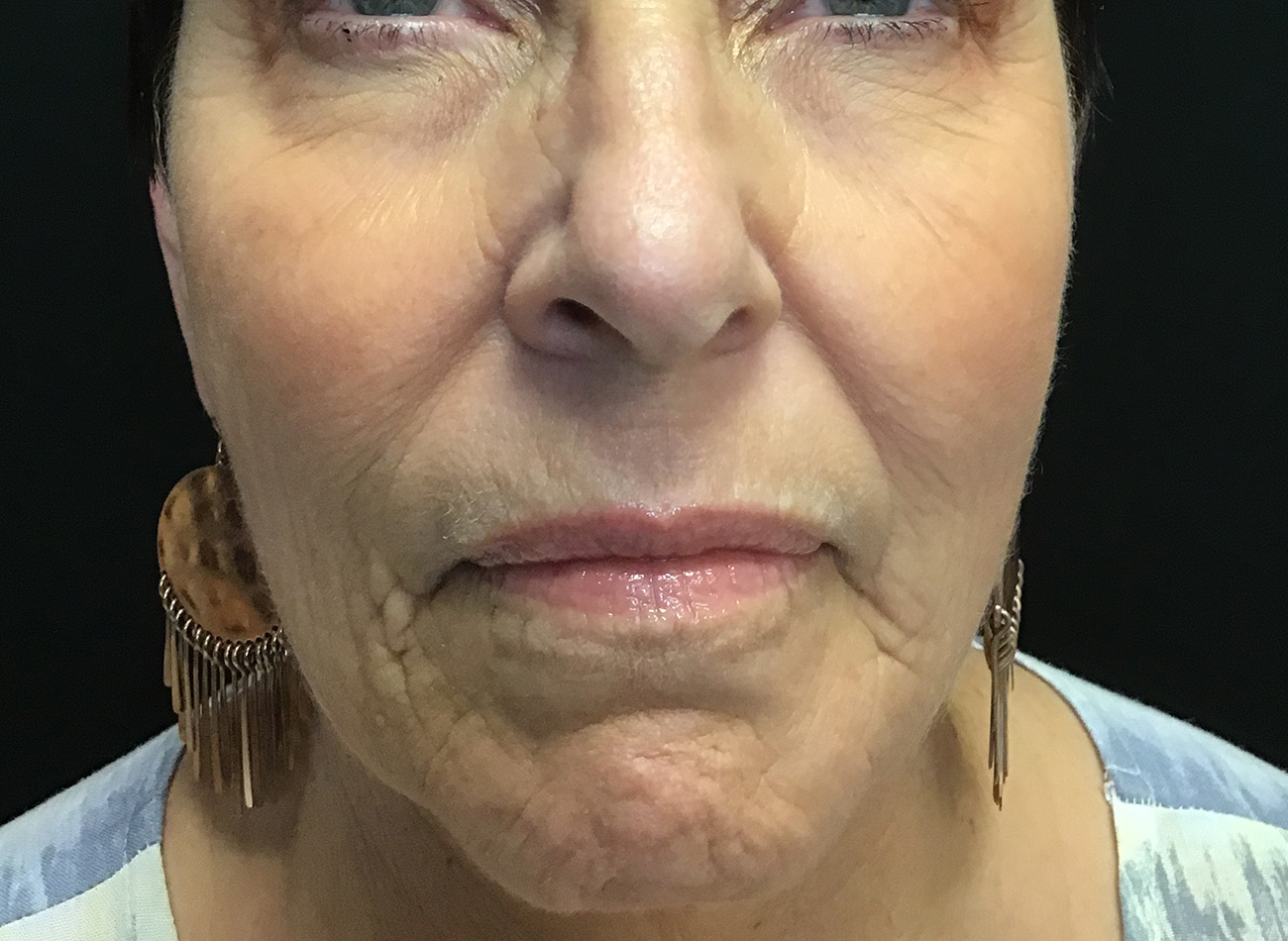 Patient #27263: Ablative Laser Before Image