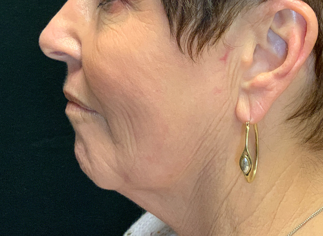 Patient #27263: Ablative Laser After Image