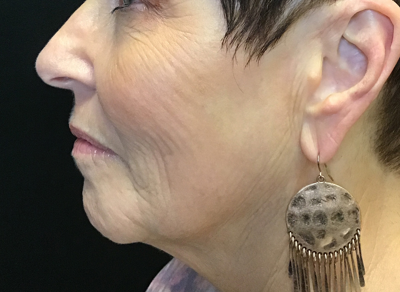 Patient #27263: Ablative Laser Before Image