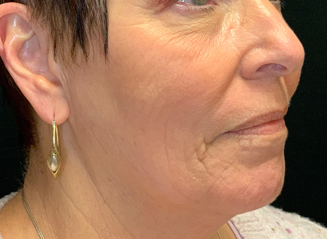 Patient #27263: Ablative Laser After Image