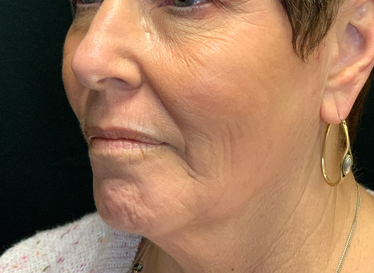 Patient #27263: Ablative Laser After Image