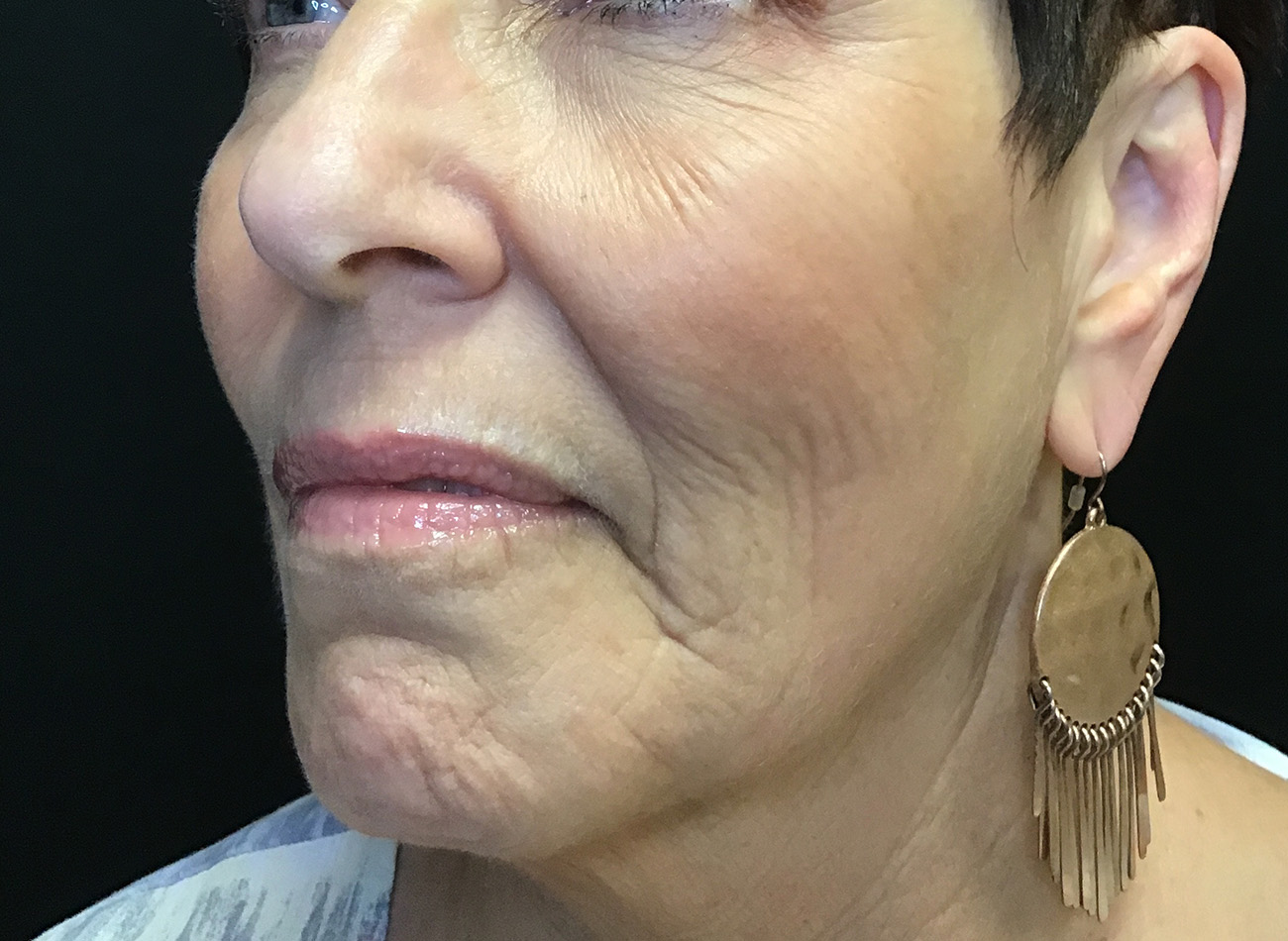 Patient #27263: Ablative Laser Before Image