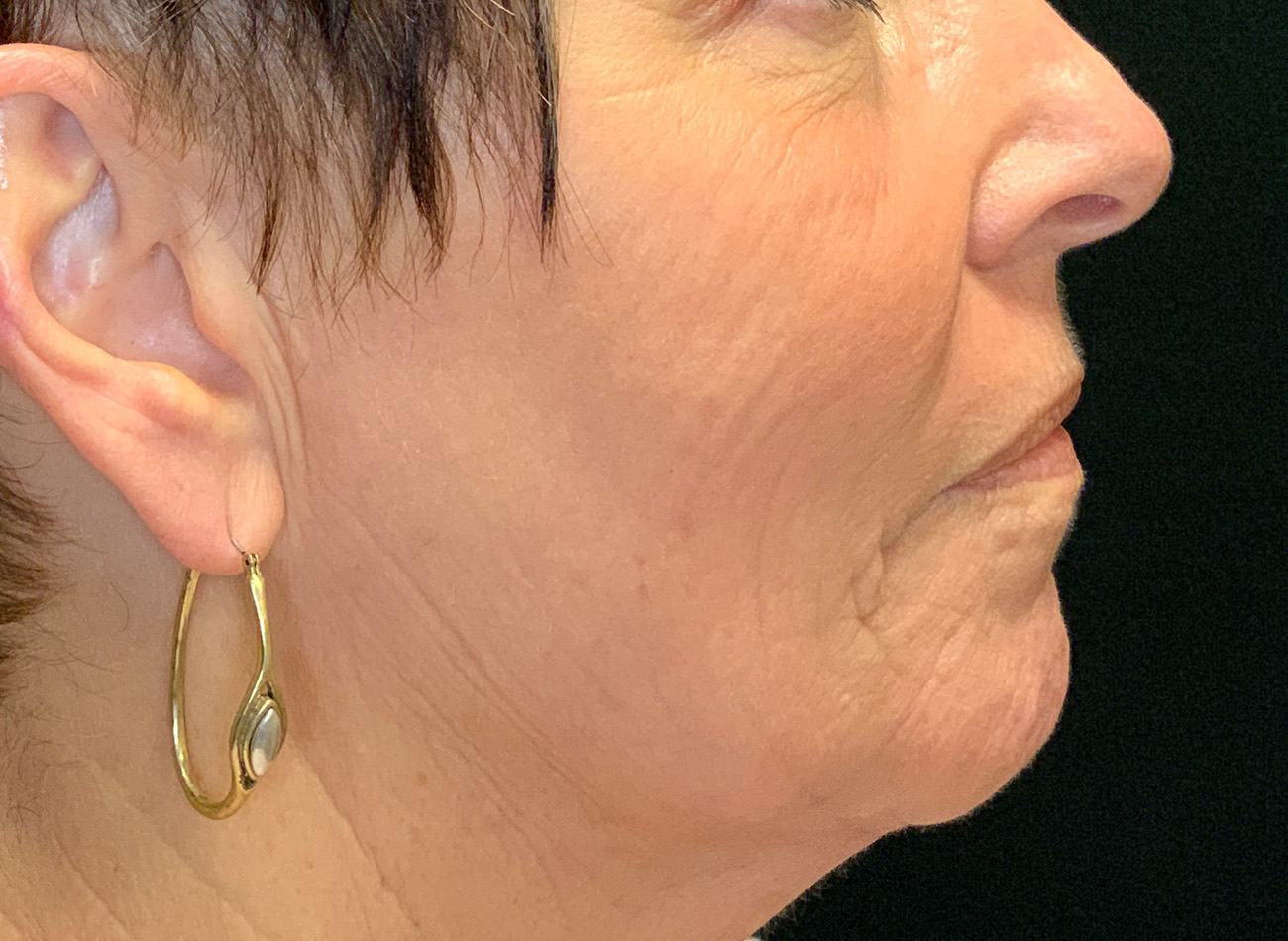 Patient #27263: Ablative Laser After Image