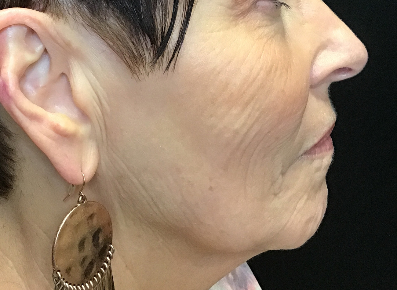 Patient #27263: Ablative Laser Before Image