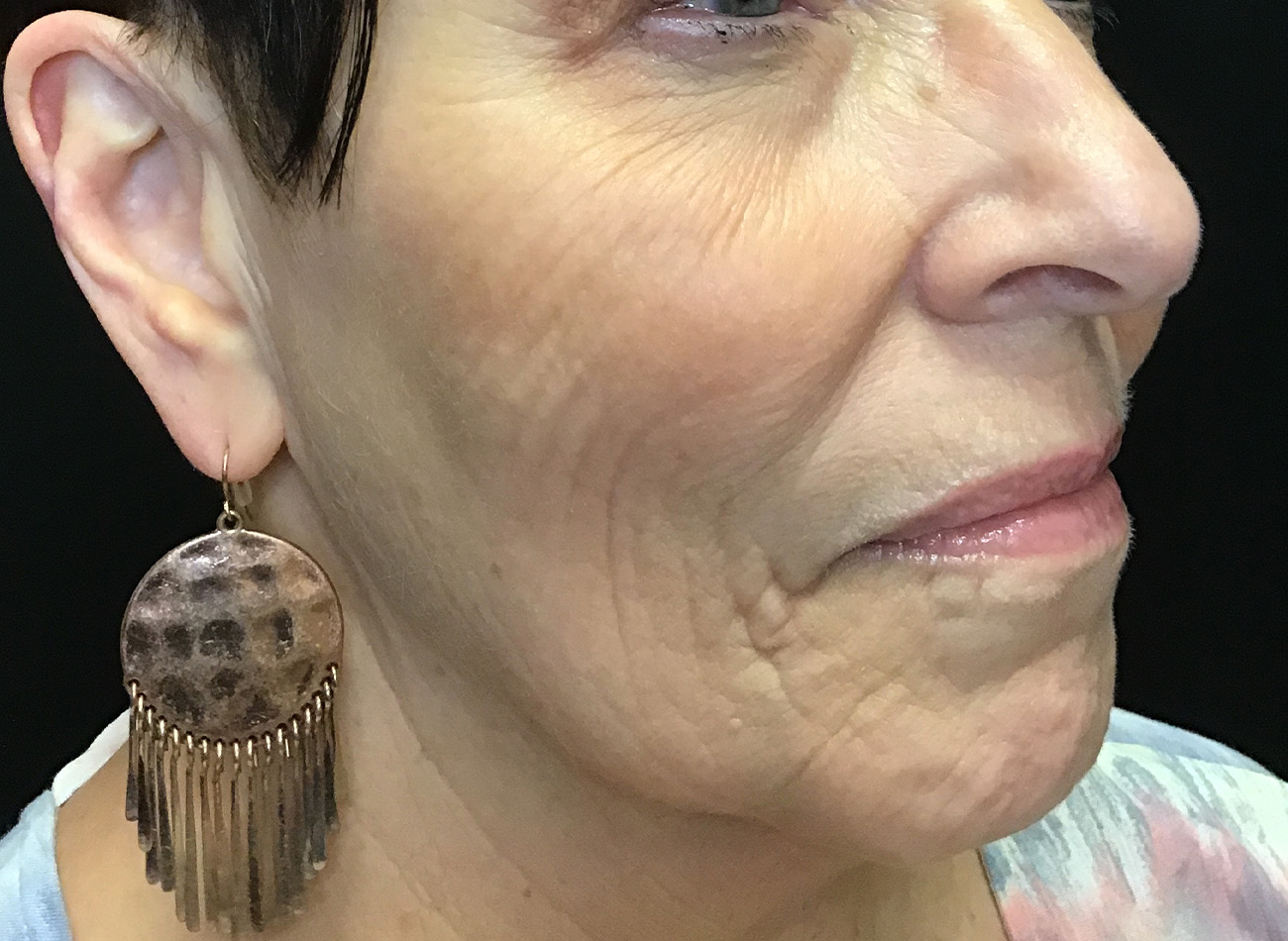 Patient #27263: Ablative Laser Before Image