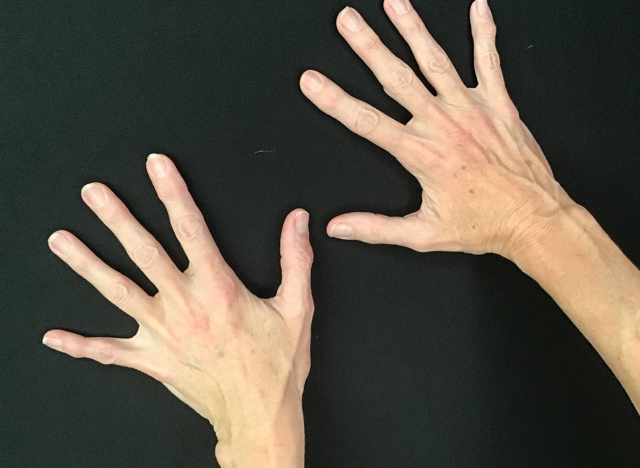Patient #68979: Hand Rejuvenation After Image