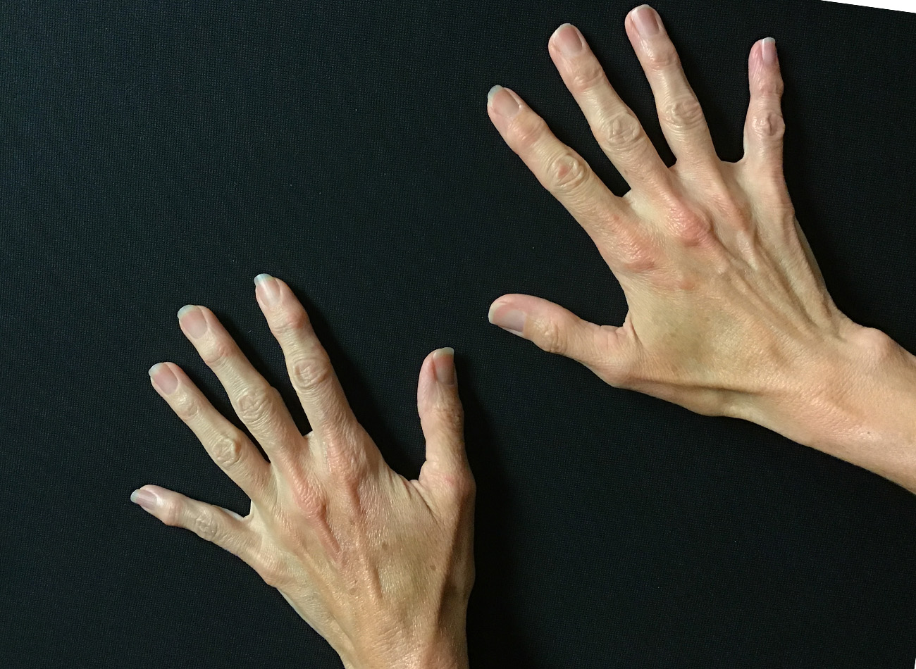 Patient #68979: Hand Rejuvenation Before Image