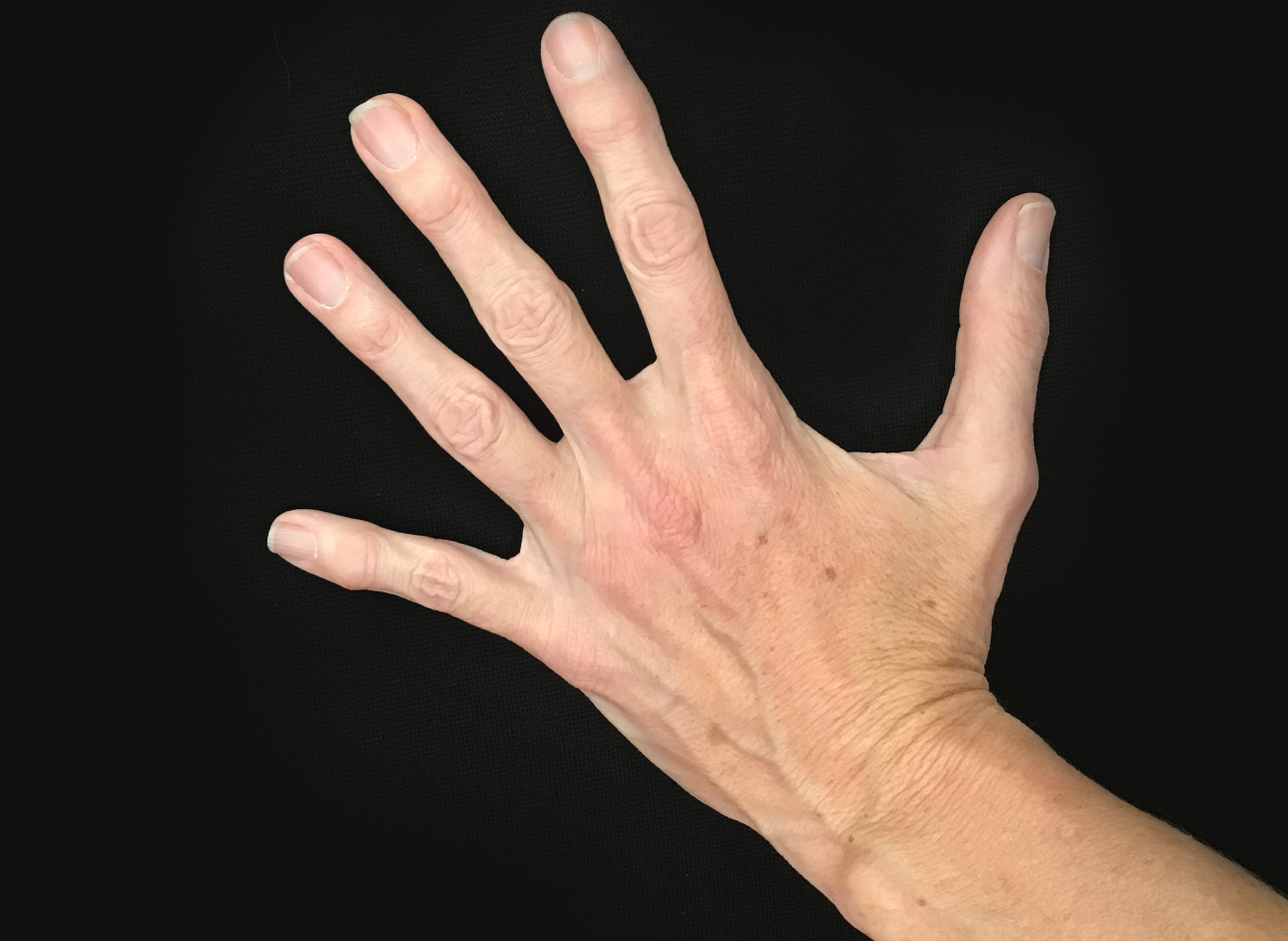 Patient #68979: Hand Rejuvenation After Image