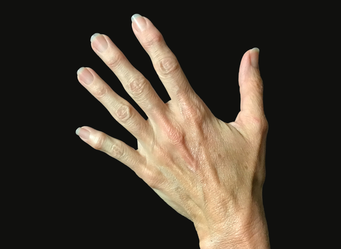 Patient #68979: Hand Rejuvenation Before Image