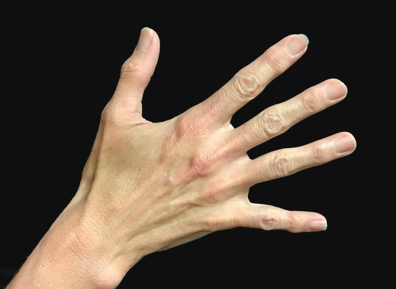 Patient #68979: Hand Rejuvenation After Image