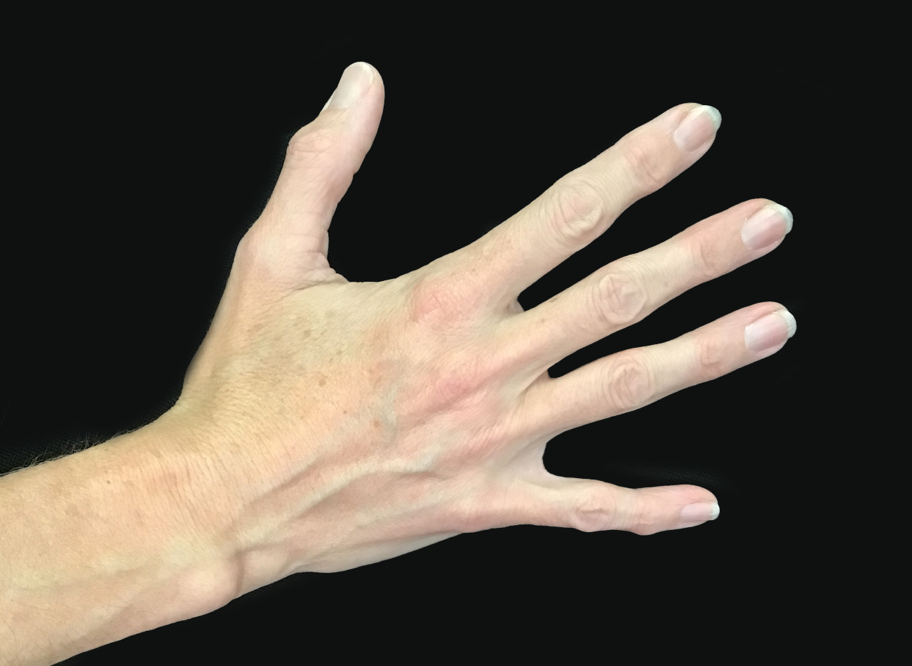 Patient #68979: Hand Rejuvenation Before Image